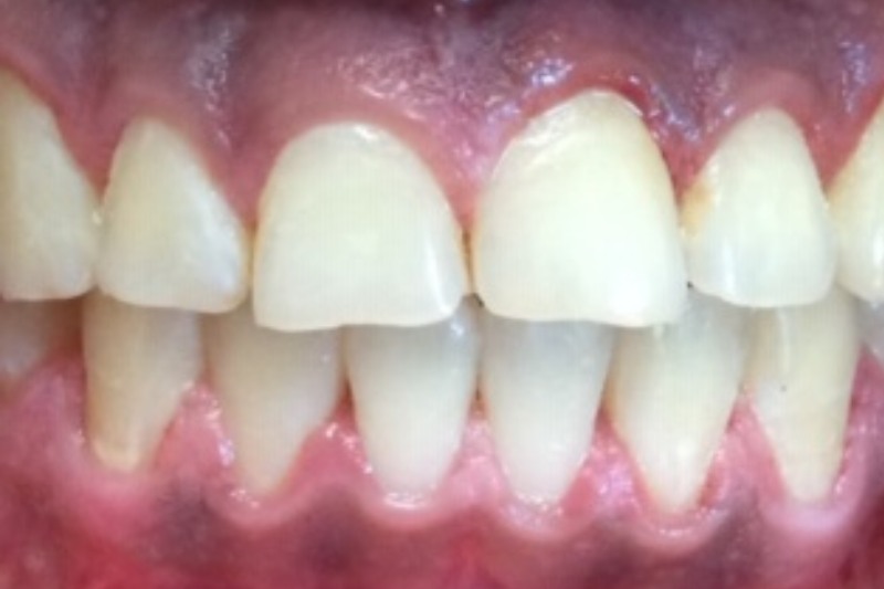 Before teeth