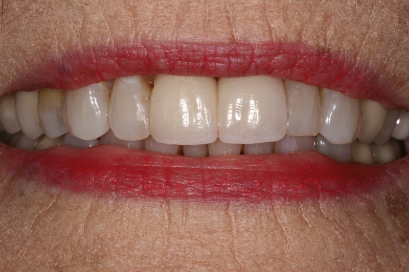 Marjorie veneers after smile photo