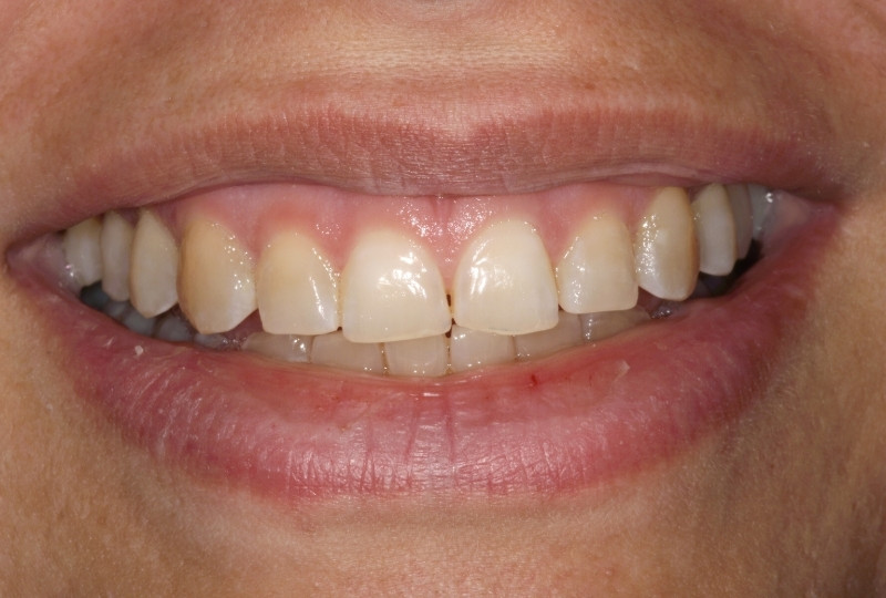 patient before veneers