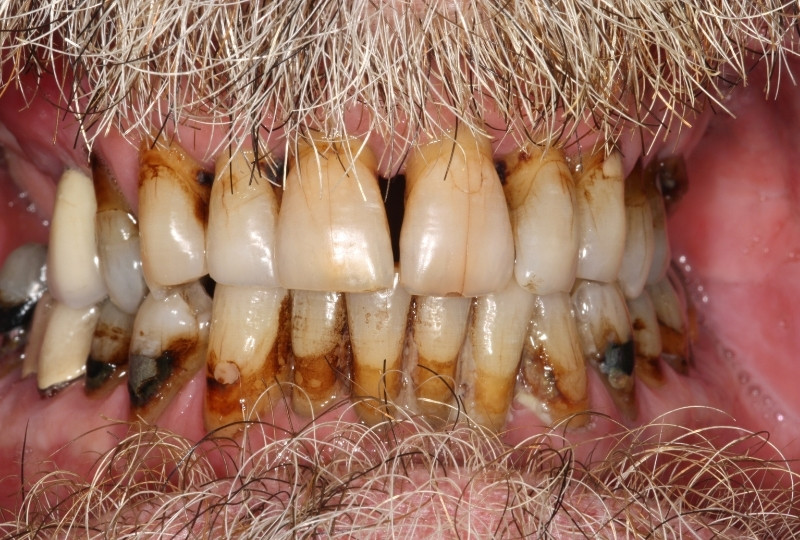 bernard before dentures