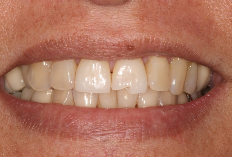 melinda before veneers