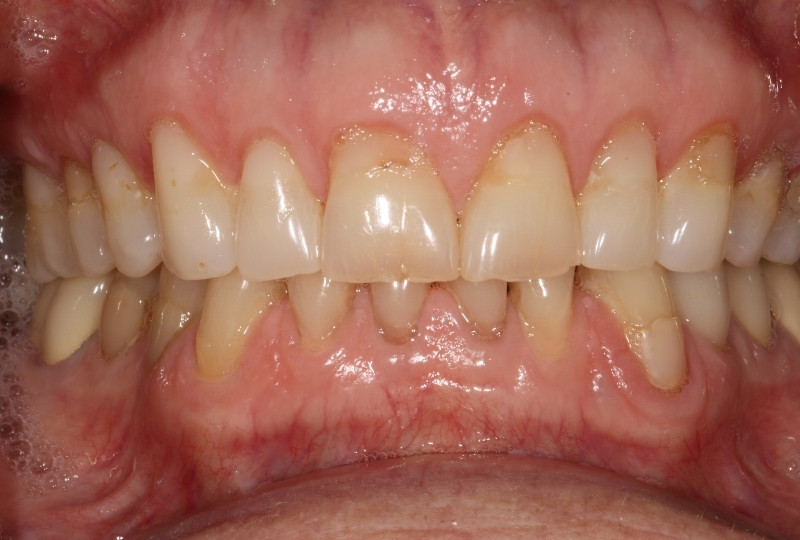 Francine before veneers