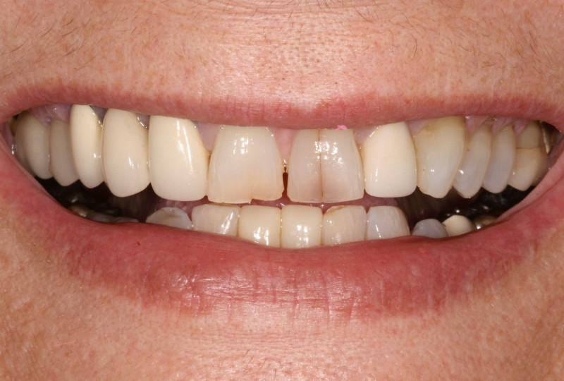 carol before veneers