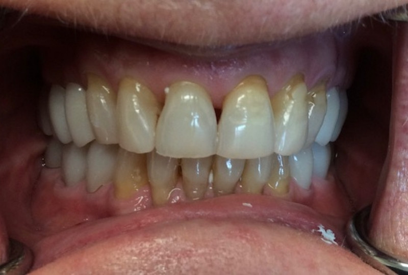 Jeanessa before veneers