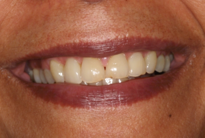 Deborah before veneers
