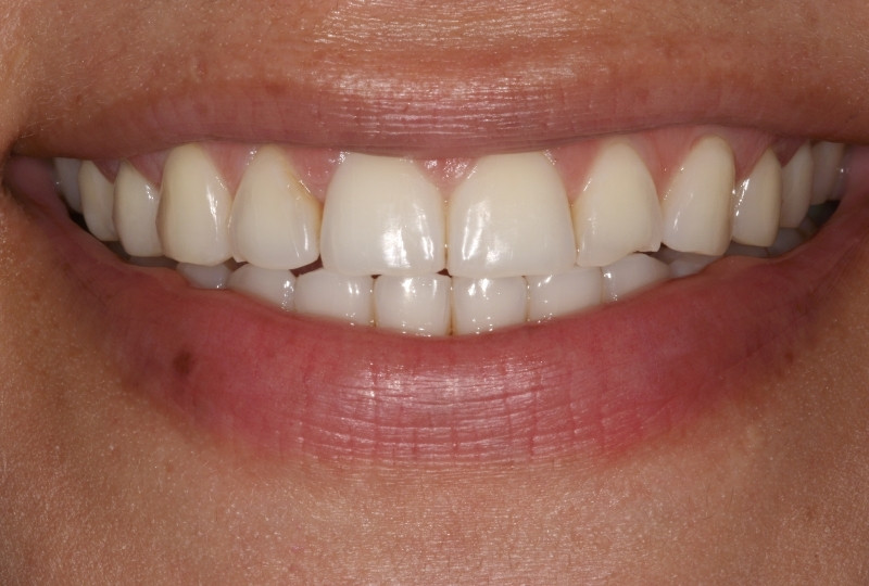 Lorena before veneers