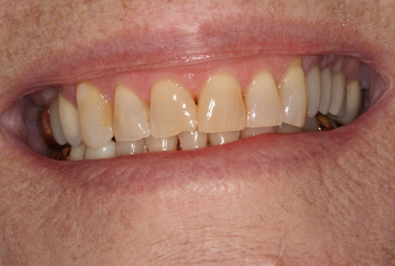 sharon before veneers