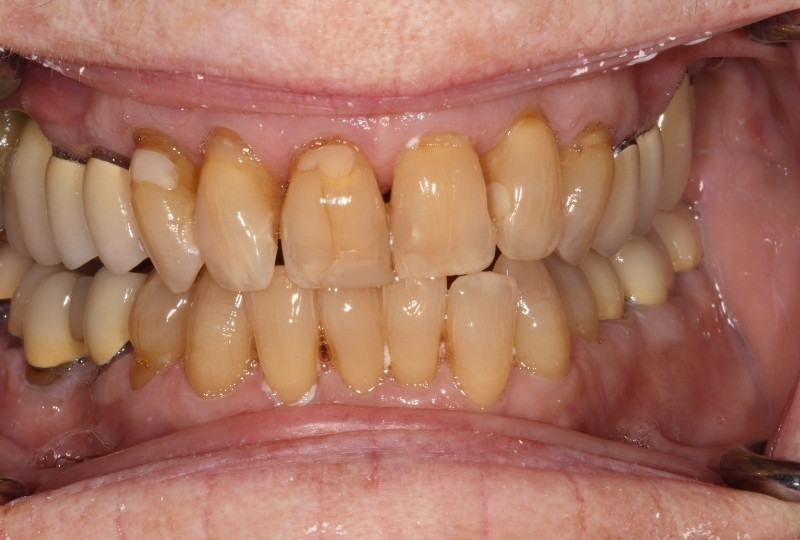 Barbara before veneers