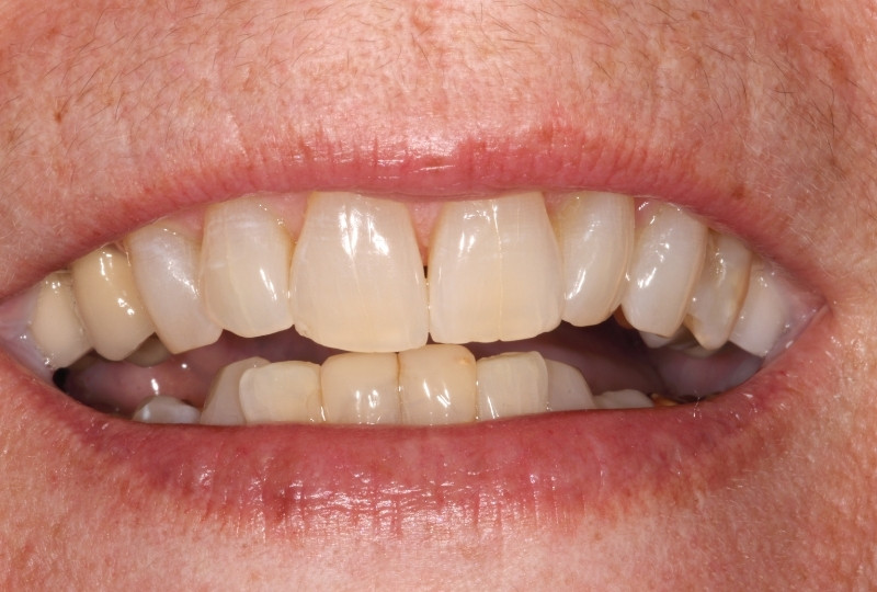 kenny before veneers