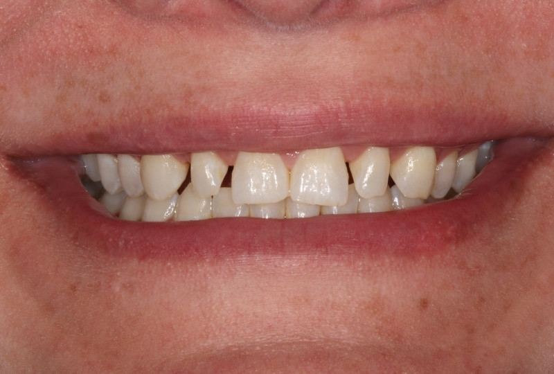 veneers before
