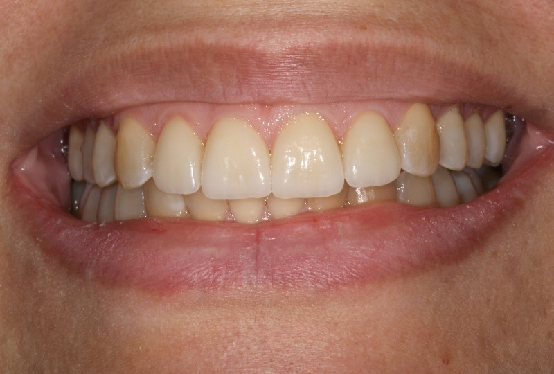 patient after veneers