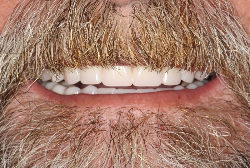 bernard after dentures