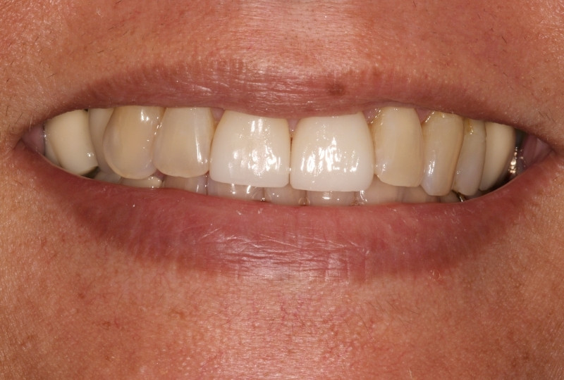 melinda after veneers