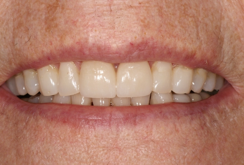 Francine after veneers