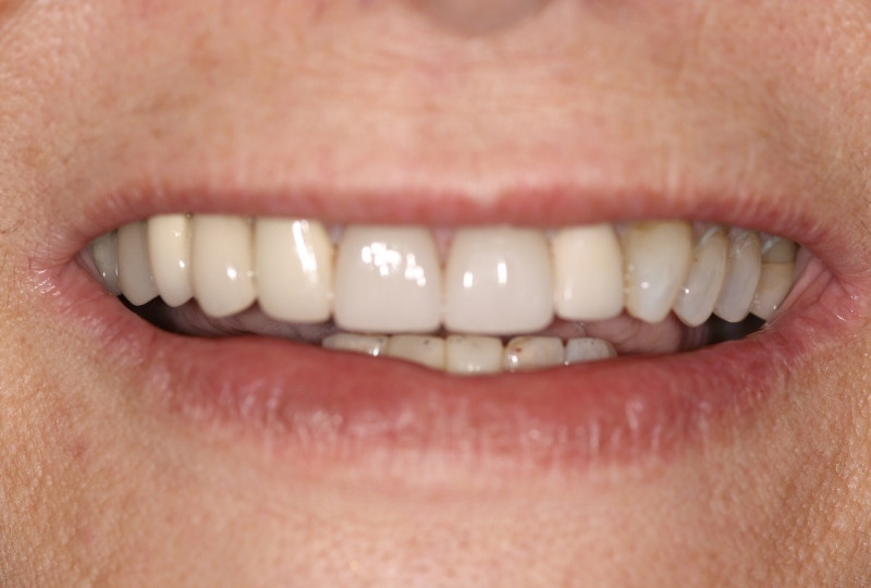 carol after veneers