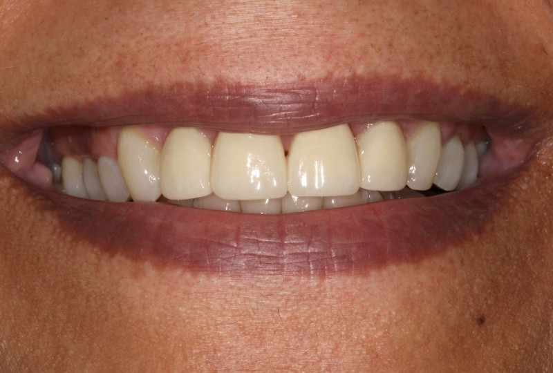 Deborah after veneers