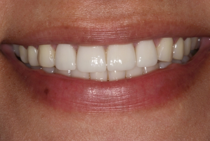 Lorena after veneers