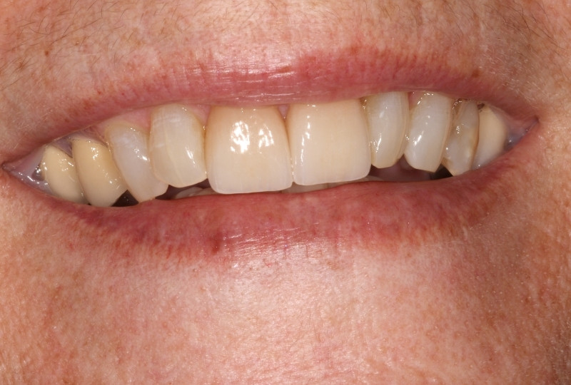 kenny before veneers