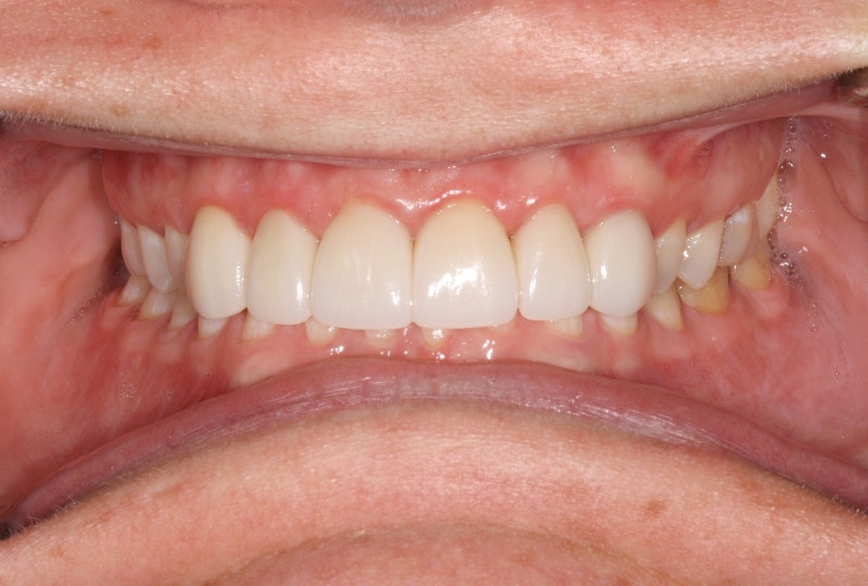 veneers after