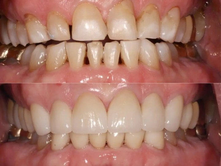 tom a before and after dental procedure