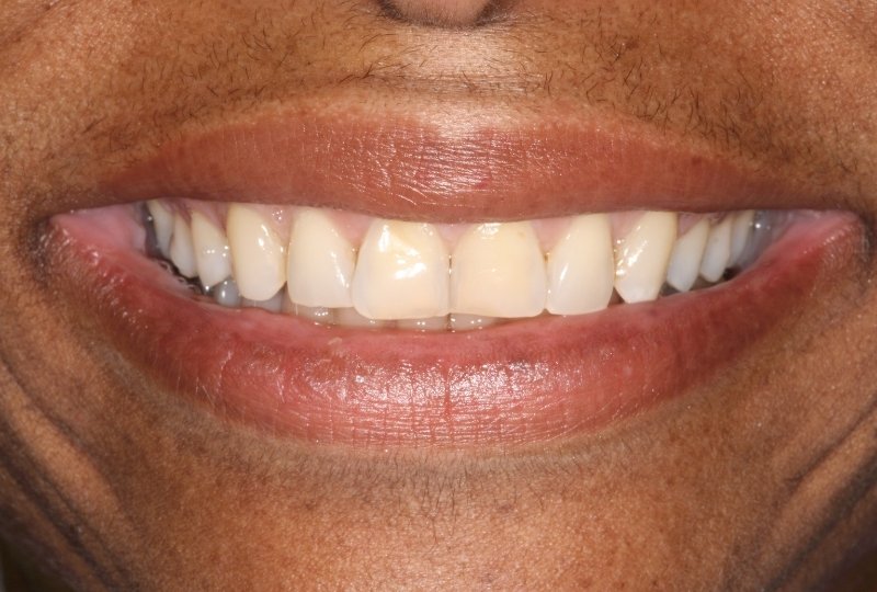 sanita before veneers